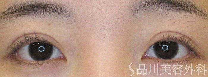 症例NO.70295のAFTER写真