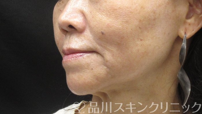 症例NO.73190のAFTER写真