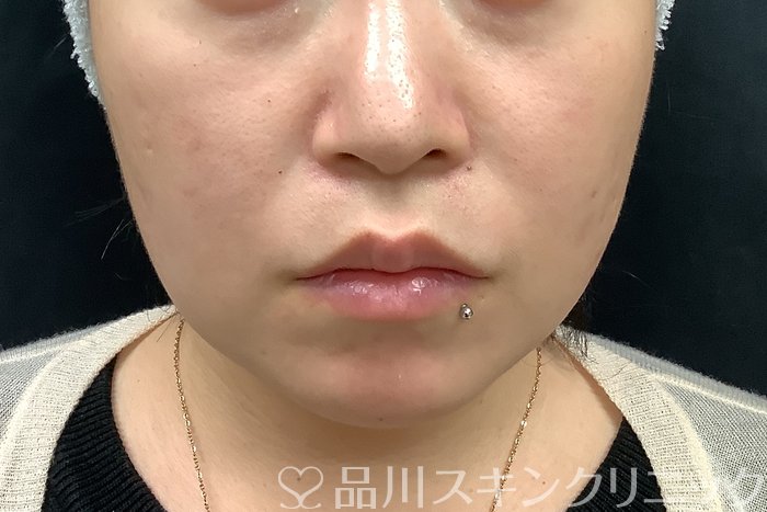 症例NO.69513のBEFORE写真
