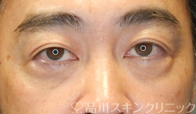 症例NO.65423のAFTER写真