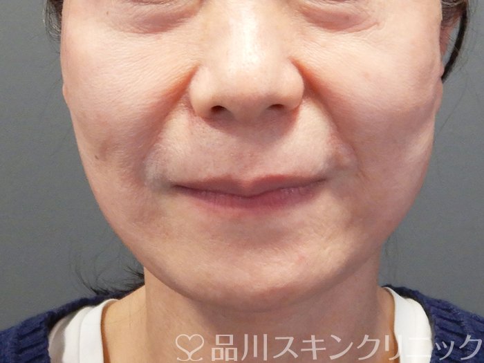 症例NO.73523のAFTER写真