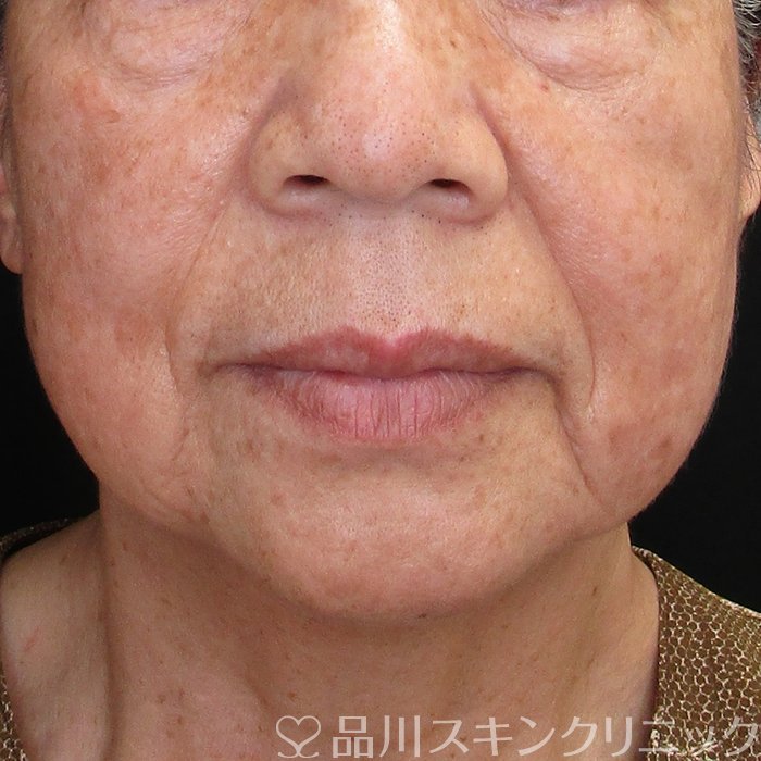 症例NO.72887のBEFORE写真