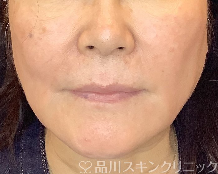 症例NO.69952のAFTER写真