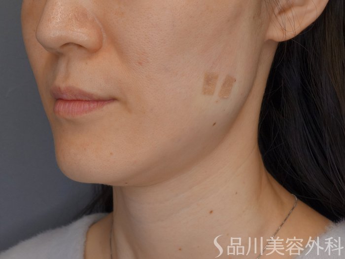 症例NO.72283のAFTER写真
