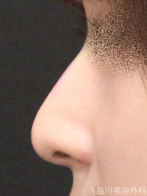 症例NO.75260のAFTER写真