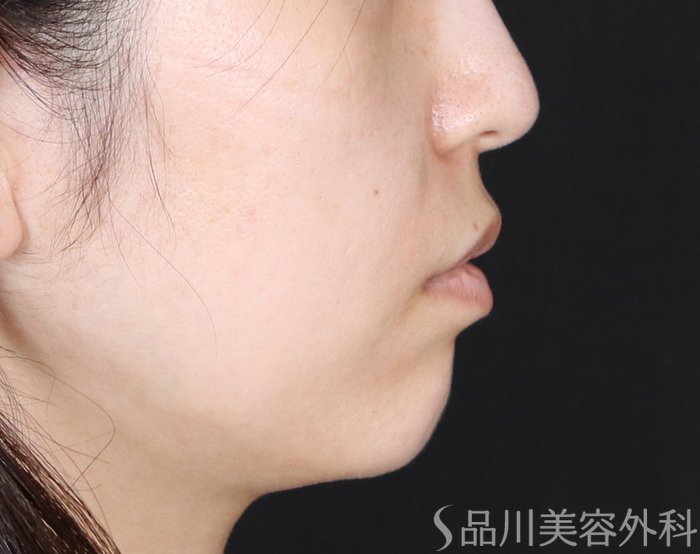 症例NO.71303のBEFORE写真