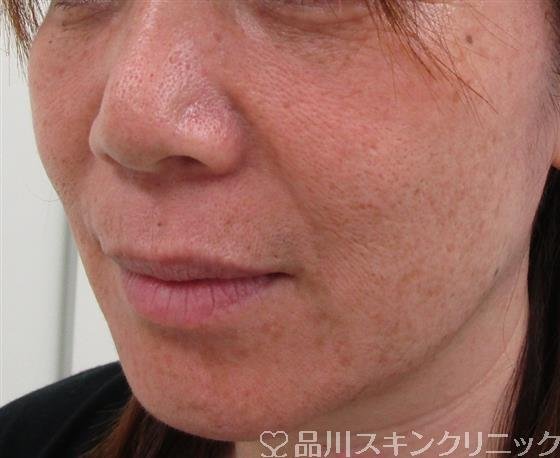 症例NO.30748のBEFORE写真