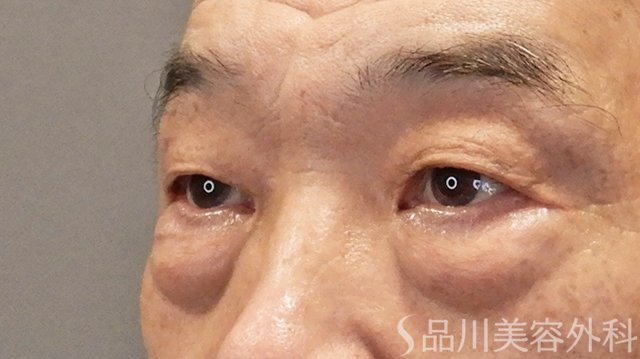 症例NO.75223のBEFORE写真