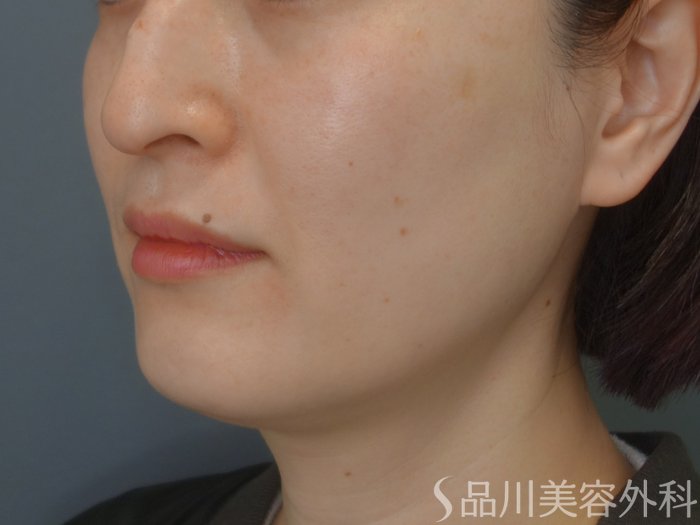 症例NO.74588のBEFORE写真