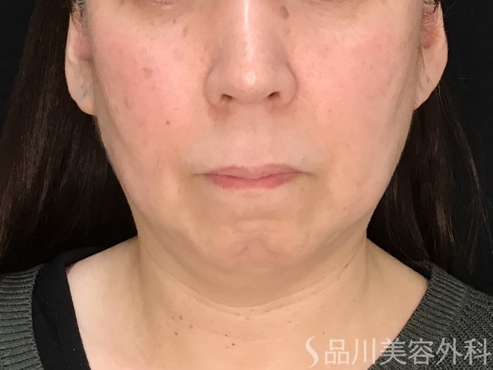 症例NO.69987のBEFORE写真
