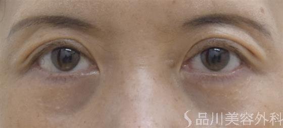 症例NO.52197のAFTER写真