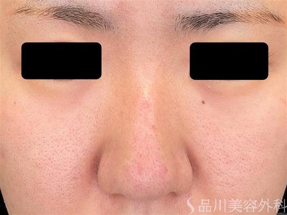 症例NO.50355のBEFORE写真