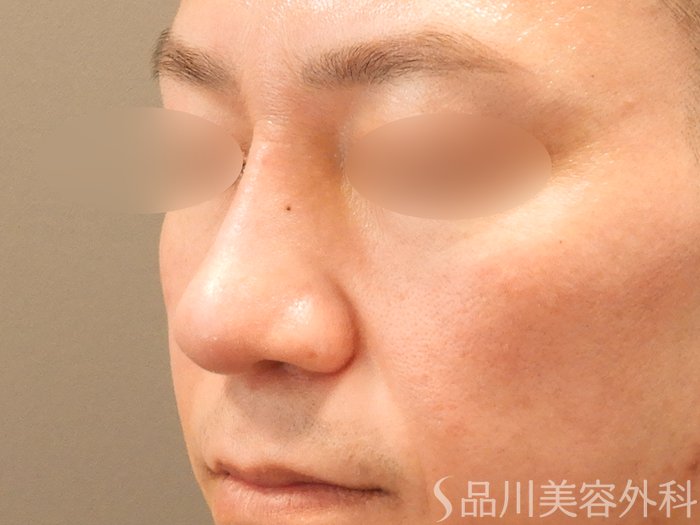 症例NO.70638のAFTER写真