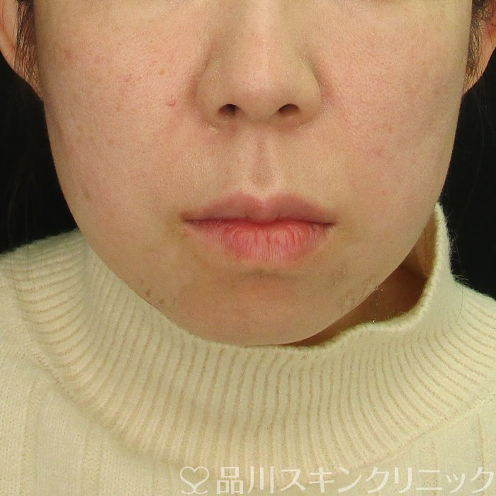 症例NO.72656のAFTER写真