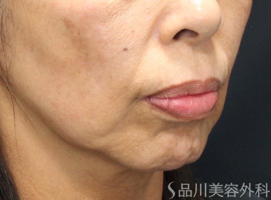 症例NO.74627のBEFORE写真