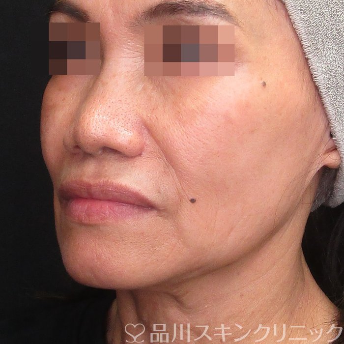 症例NO.73805のBEFORE写真