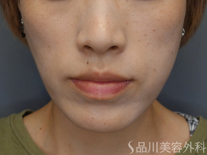 症例NO.71904のBEFORE写真