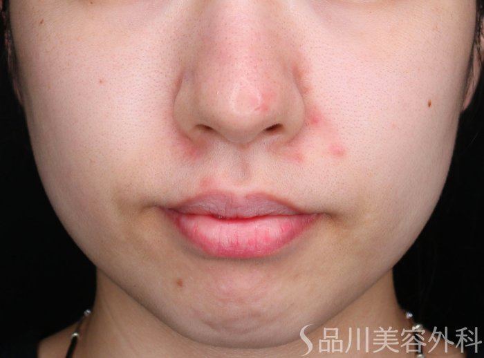 症例NO.72046のBEFORE写真