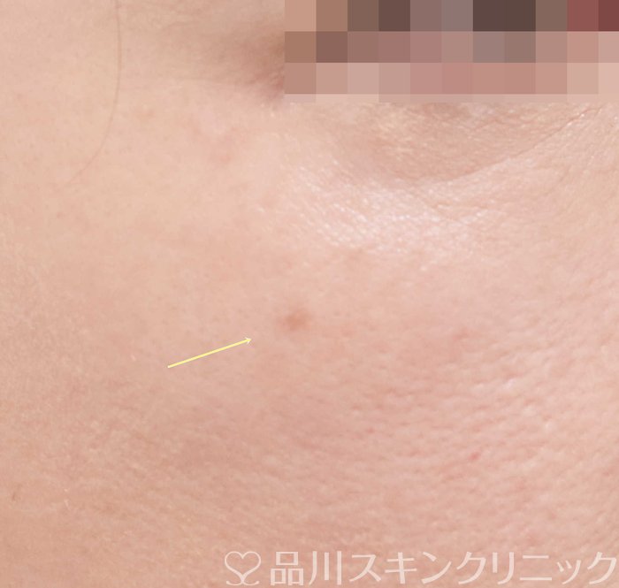 症例NO.70488のBEFORE写真