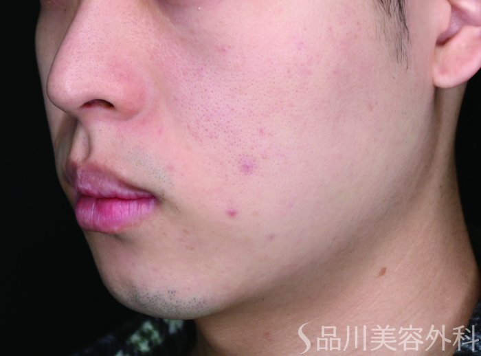 症例NO.72701のBEFORE写真