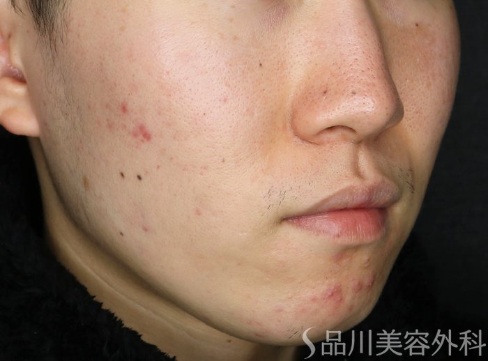 症例NO.74610のBEFORE写真