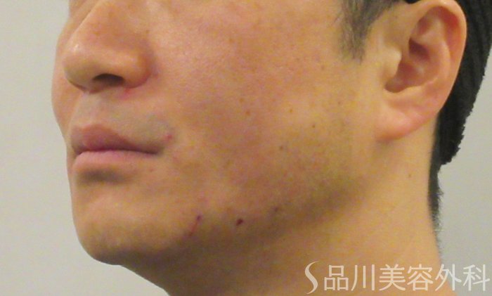 症例NO.73336のAFTER写真