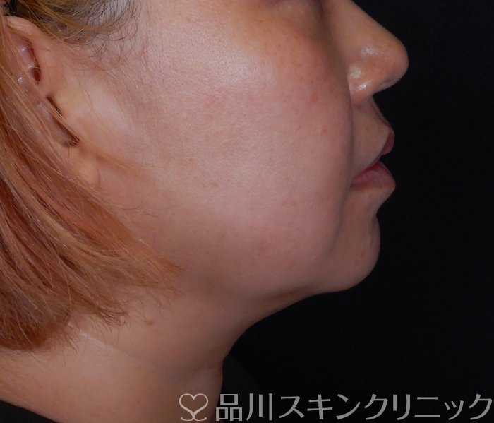 症例NO.66910のBEFORE写真