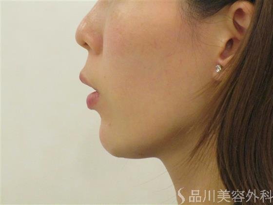 症例NO.54796のAFTER写真