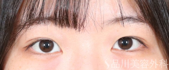 症例NO.71514のAFTER写真
