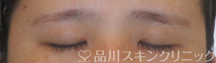 症例NO.64312のAFTER写真
