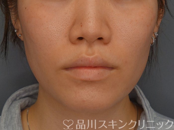 症例NO.74011のBEFORE写真