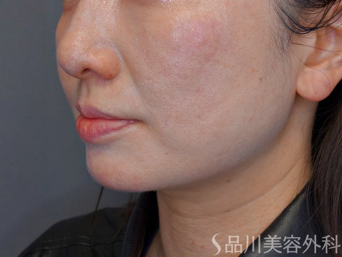 症例NO.74815のBEFORE写真
