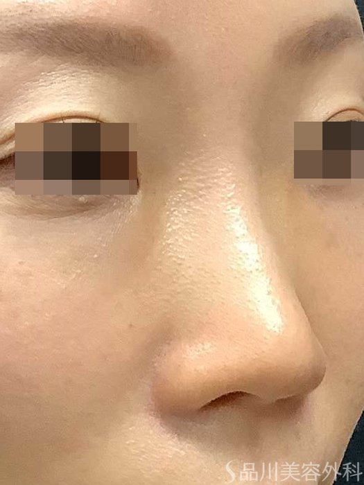 症例NO.69703のBEFORE写真