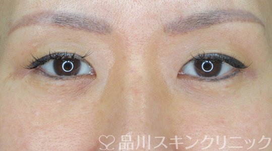 症例NO.69634のBEFORE写真