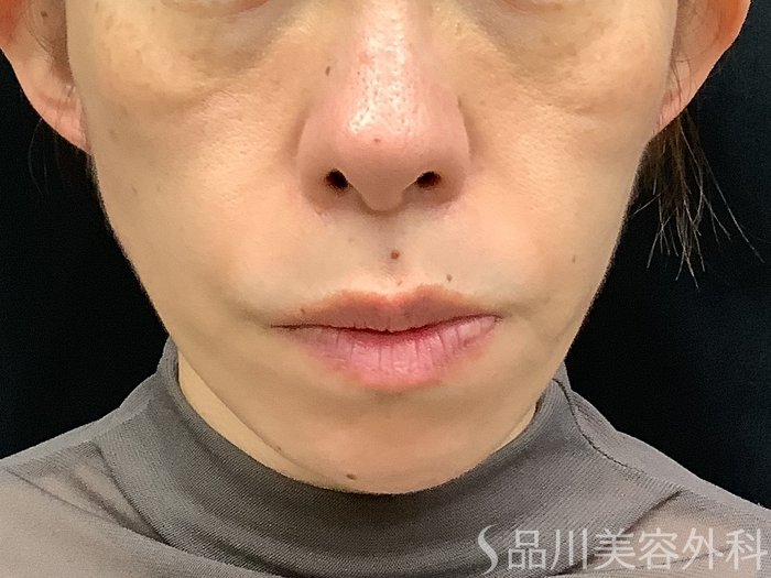 症例NO.67760のBEFORE写真