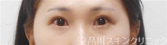 症例NO.43027のAFTER写真
