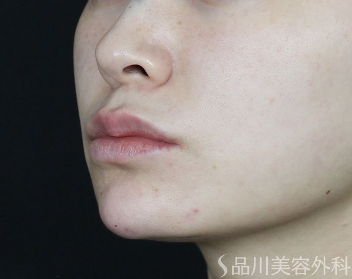 症例NO.70213のAFTER写真