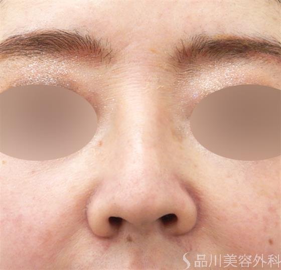 症例NO.53639のBEFORE写真