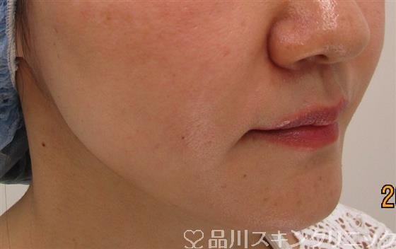 症例NO.35438のAFTER写真