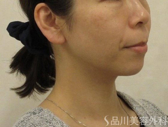 症例NO.73554のBEFORE写真