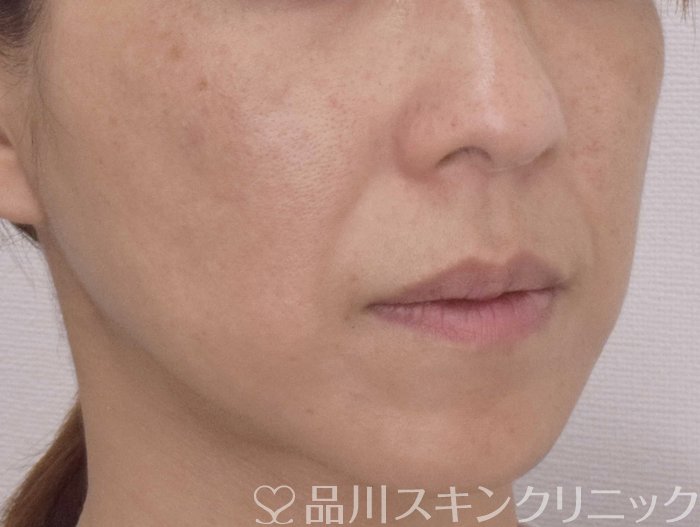 症例NO.72314のBEFORE写真