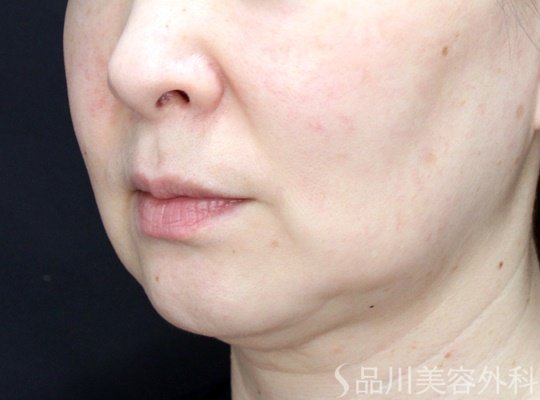 症例NO.70344のBEFORE写真