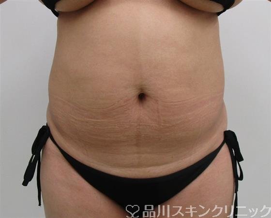 症例NO.35946のBEFORE写真