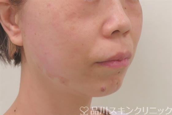 症例NO.56664のAFTER写真