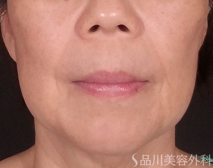 症例NO.70694のBEFORE写真