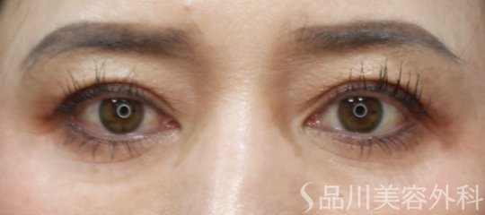症例NO.75148のAFTER写真