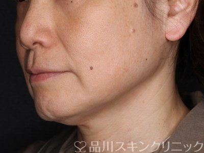 症例NO.71185のAFTER写真