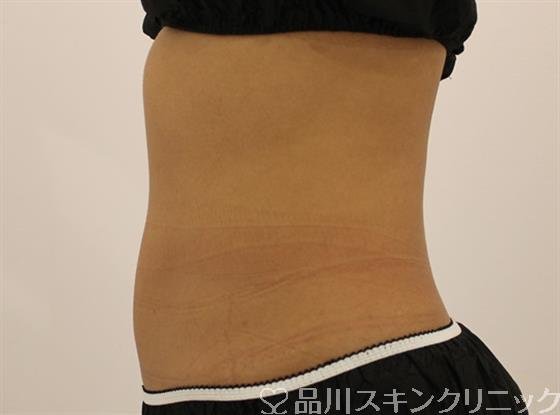 症例NO.45542のAFTER写真