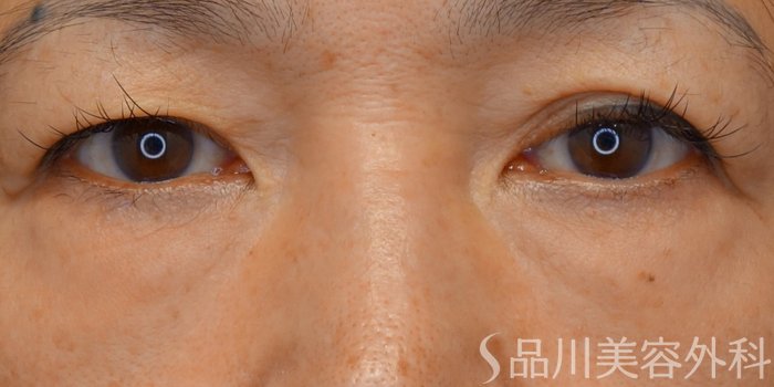 症例NO.72222のBEFORE写真