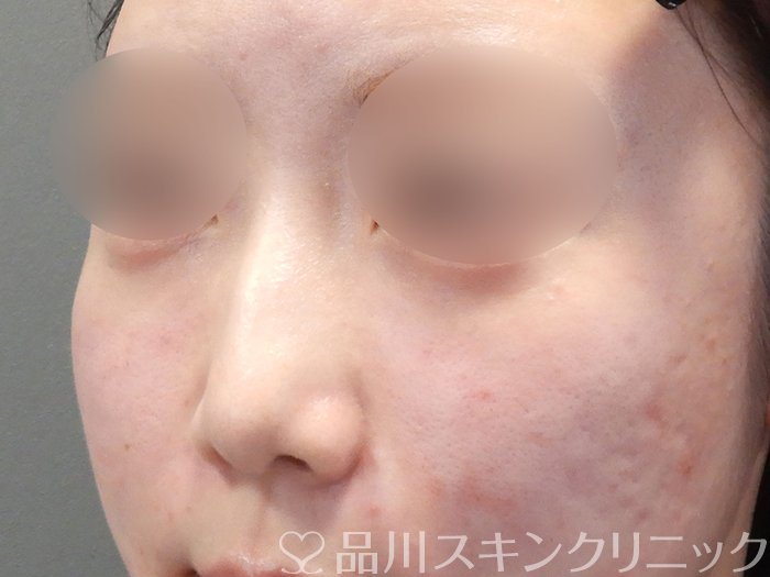 症例NO.72695のAFTER写真